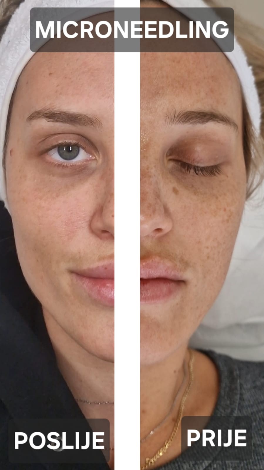 Adentis #zagreb Tretman lica Microneedling - lice