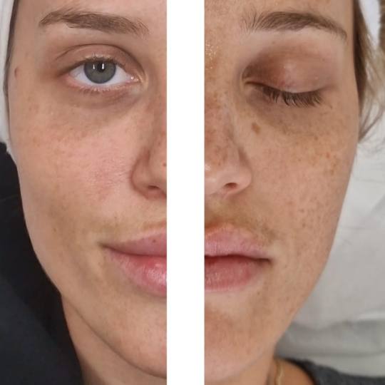 Adentis #zagreb Tretman lica Microneedling - lice