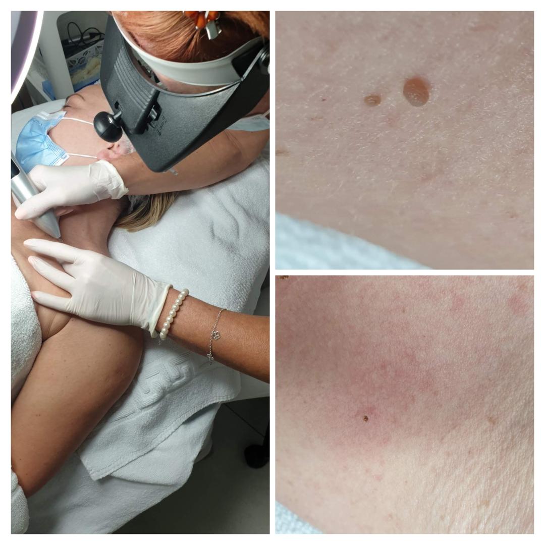 Plasmapen - uklanjanje fibroma / keratoza - Cosmoderm & Centar Estetica, Zagreb Tretman lica Lice Tretman lica, Zagreb, Trnje