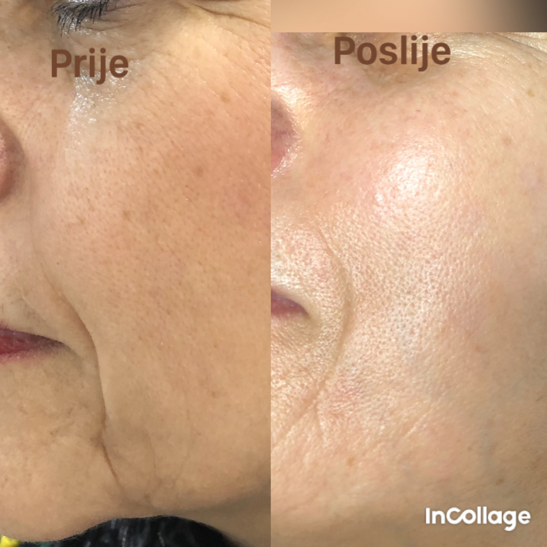FeelUnique #zagreb Tretman lica Nana i Gaba lift therapy + microneedling - lifting / pomlađivanje