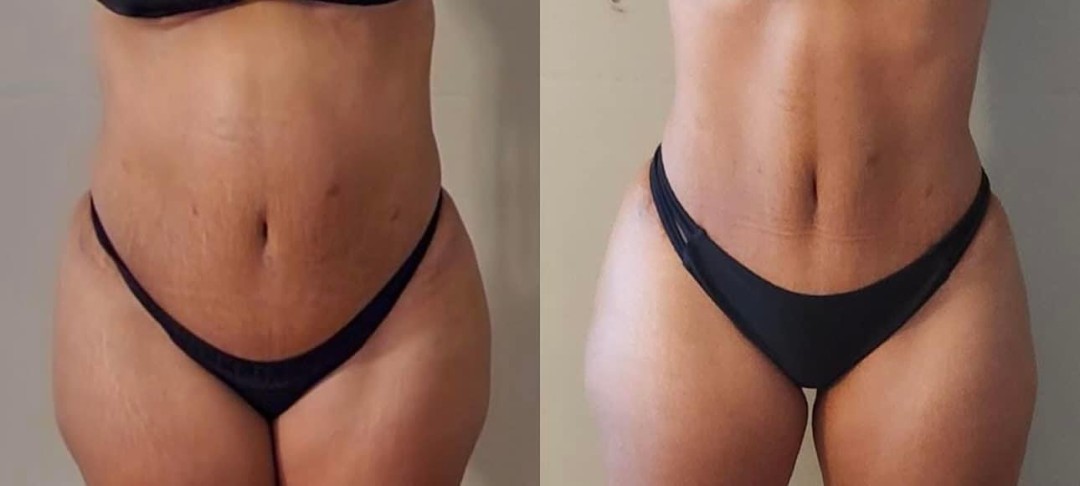 Estetix centar #zagreb Tretmani tijela Mega paket tretmana