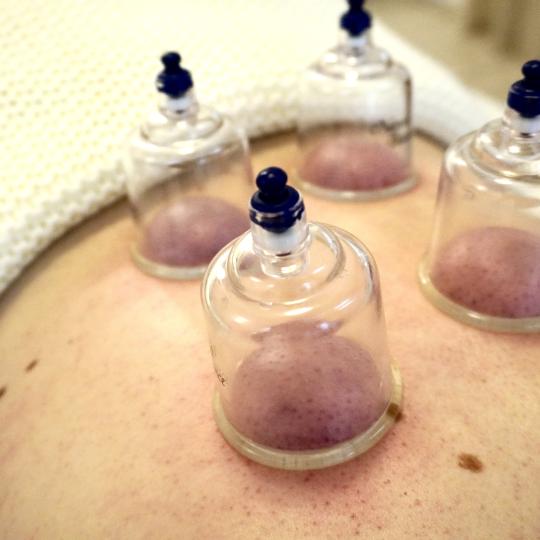 Reaktiva #varazdin Masaža za mršavljenje Cupping tehnika Cupping tehnika u sklopu fizioterapeutsko