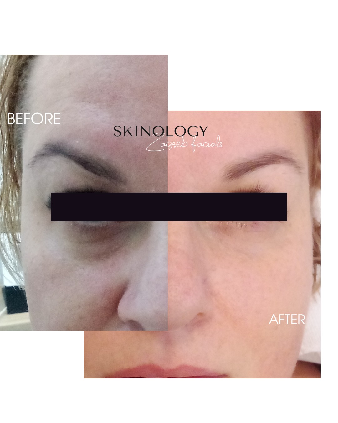 MesoAge - Skinology Zagreb facials, Zagreb Tretman lica Lice Tretman lica, Zagreb, Donji grad - Centar