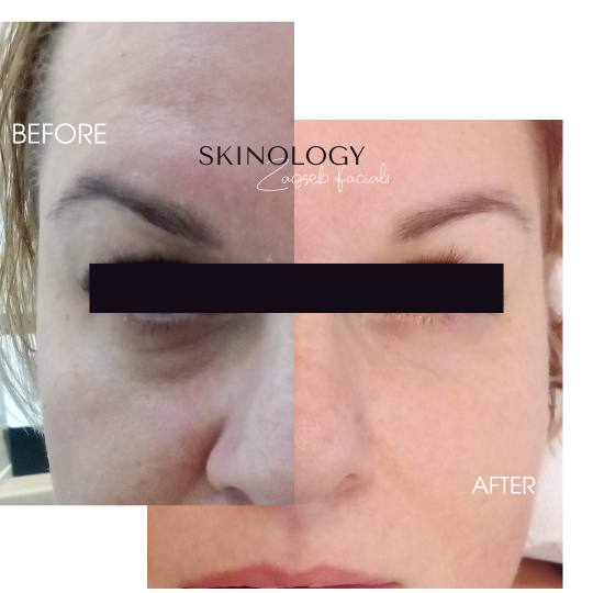 Skinology Zagreb facials #zagreb Tretman lica MesoAge