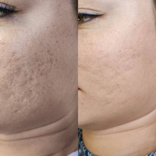 Angela #zagreb Uklanjanje akni nakon posta