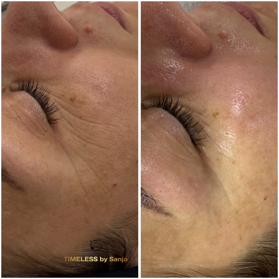 Timeless by Sanja #zagreb Tretman lica InspiraMed medi lift