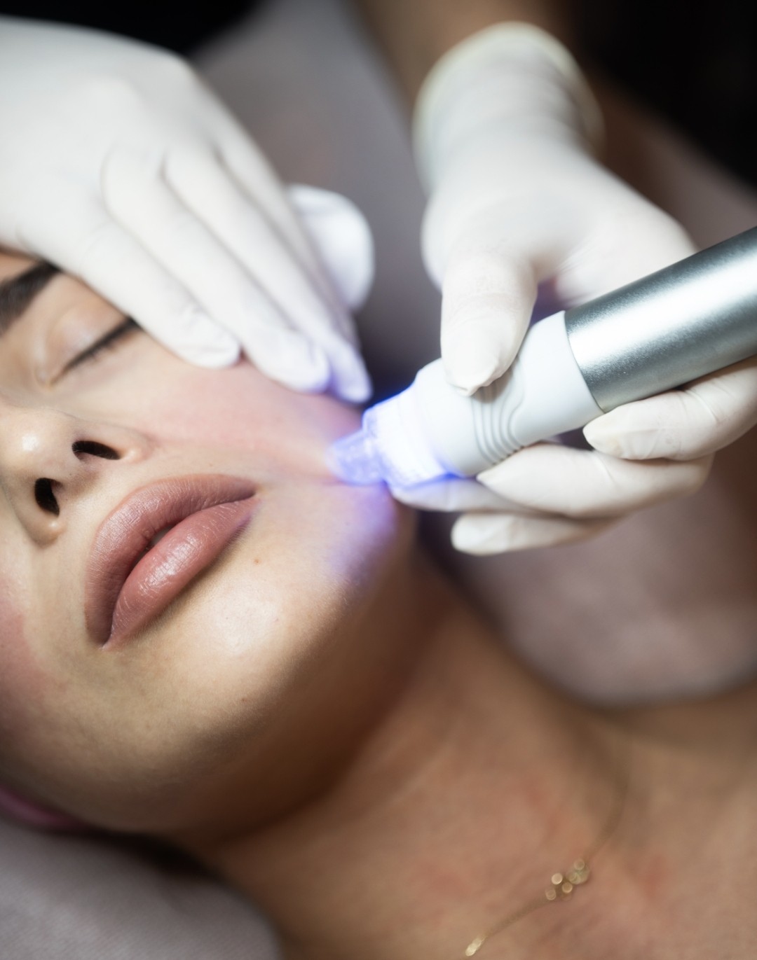 SOLO Beauty Centar #zagreb Tretman lica HydraFacial Premium