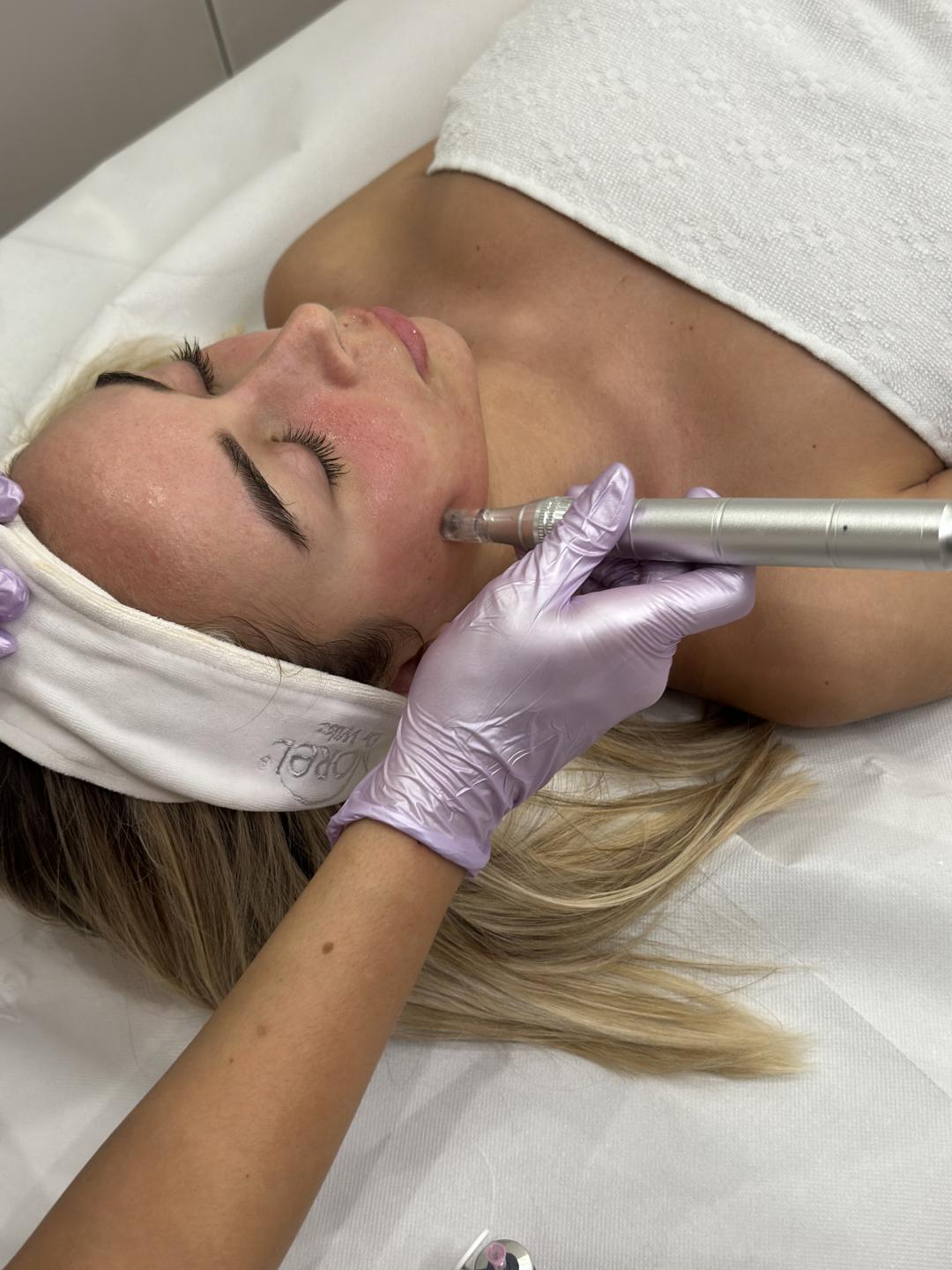 Beauty Box - Zagreb #zagreb Tretman lica Microneedling