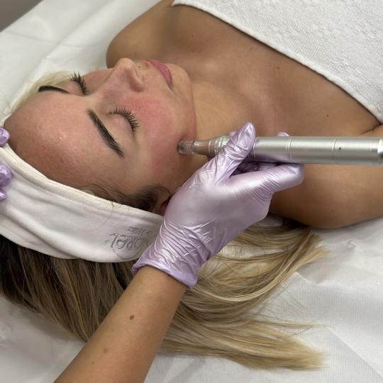 Beauty Box - Zagreb #zagreb Tretman lica Microneedling