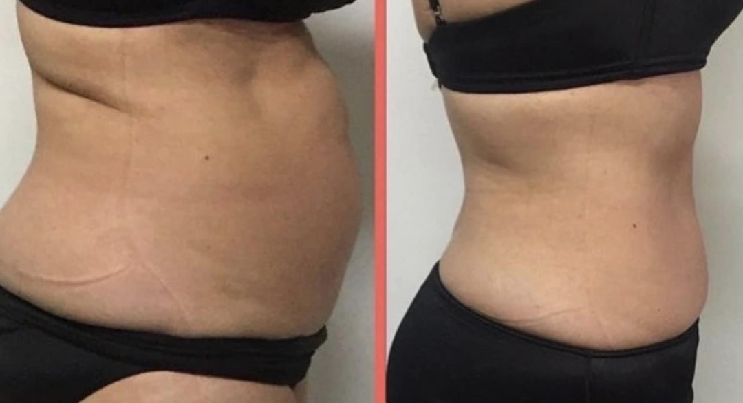 Estetix centar #zagreb Tretmani tijela Emsculpt tretman tijela - paket od 4 tretmana