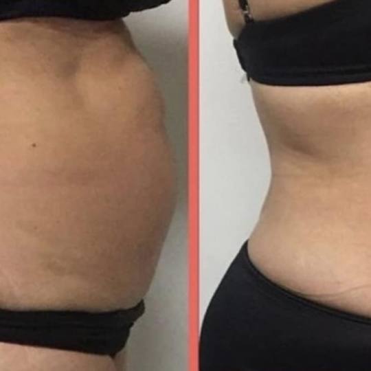 Estetix centar #zagreb Tretmani tijela Emsculpt tretman tijela - paket od 4 tretmana