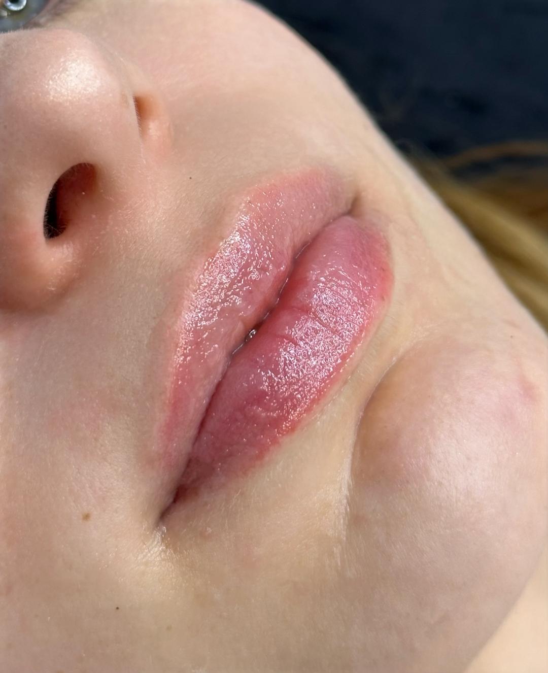 Hydra Lips - Théa Beauty Spot, Zagreb Dermaroler i dermapen Lice Dermaroler i dermapen, Zagreb, Gornja Dubrava