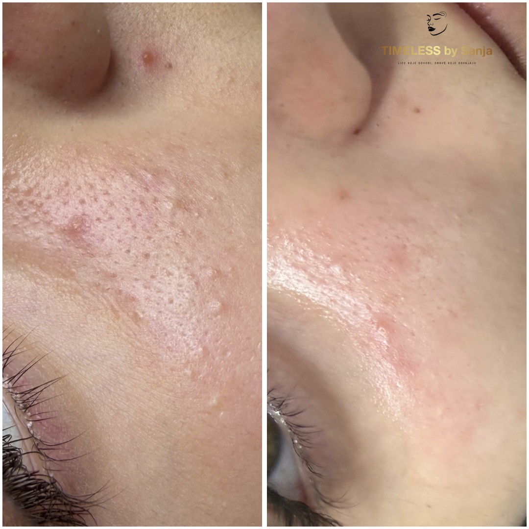 Timeless by Sanja #zagreb Piling lica Mesoestetic peeling