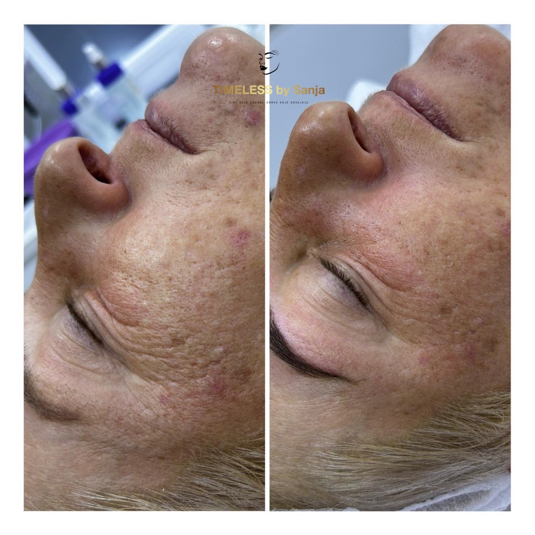 Timeless by Sanja #zagreb Tretman lica InspiraMed medi lift