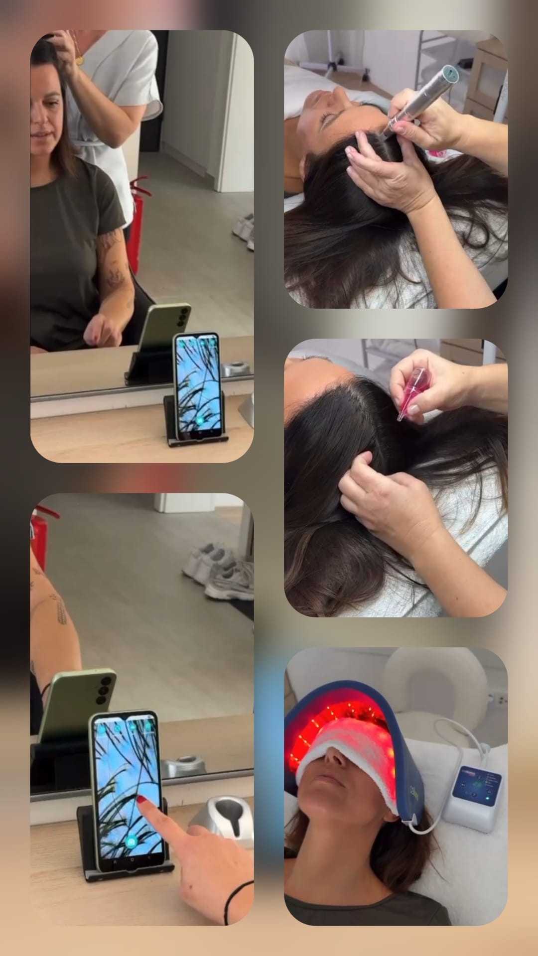 Skinergy #zagreb Tretman lica Mezoterapija - 1 zona