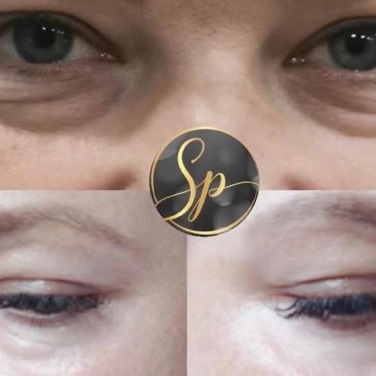 Spellar - Križ #kriz Uklanjanje podocnjaka - plasma pen tretman