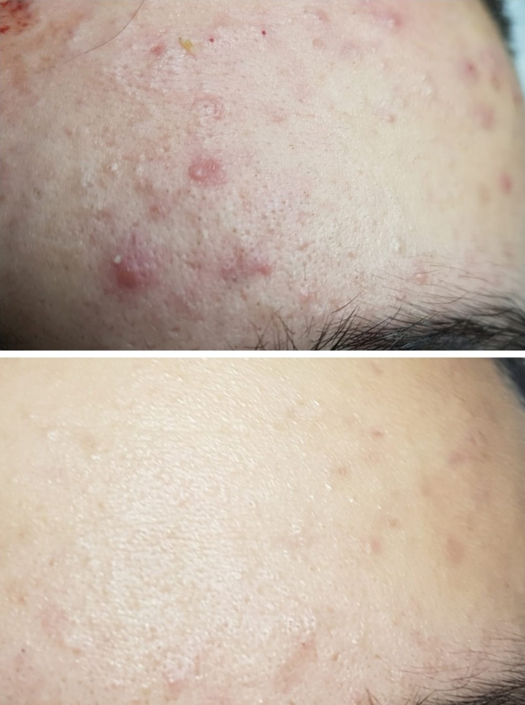 Cosmoderm & Centar Estetica #zagreb Akne Čišćenje lica - izrazito nečista koža (pregled + peeling + čišćenje + maska + masaža + njega)