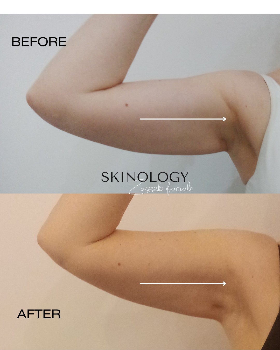 Skinology Zagreb facials #zagreb Tretman lica LPG aparativni anticelulitni tretman - paket od 5 tretmana + 1 gratis