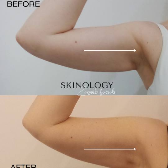 Skinology Zagreb facials #zagreb Tretman lica LPG aparativni anticelulitni tretman - paket od 5 tret