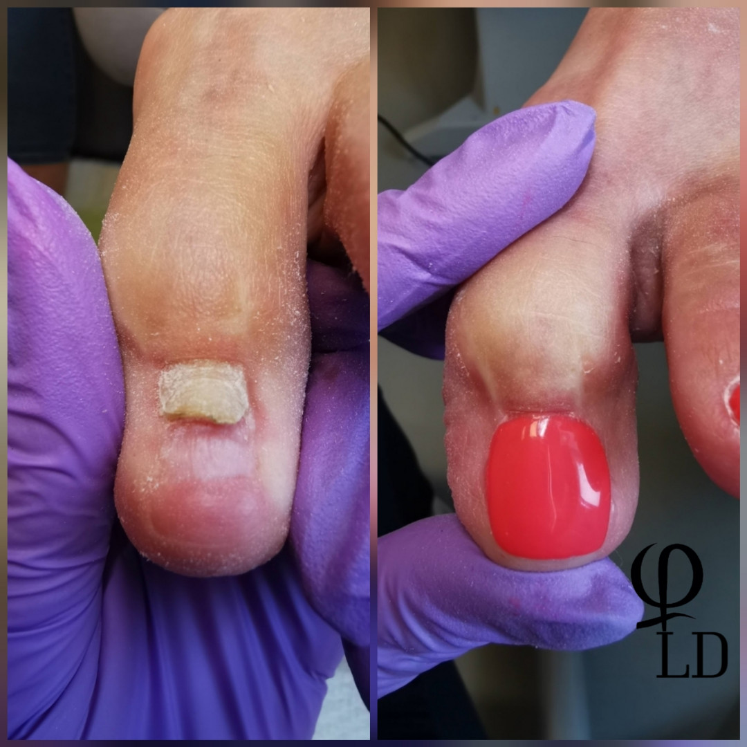 LD Beauty Centar #zagreb Estetska pedikura Rekonstrukcija nokta ( PUKNUĆE )