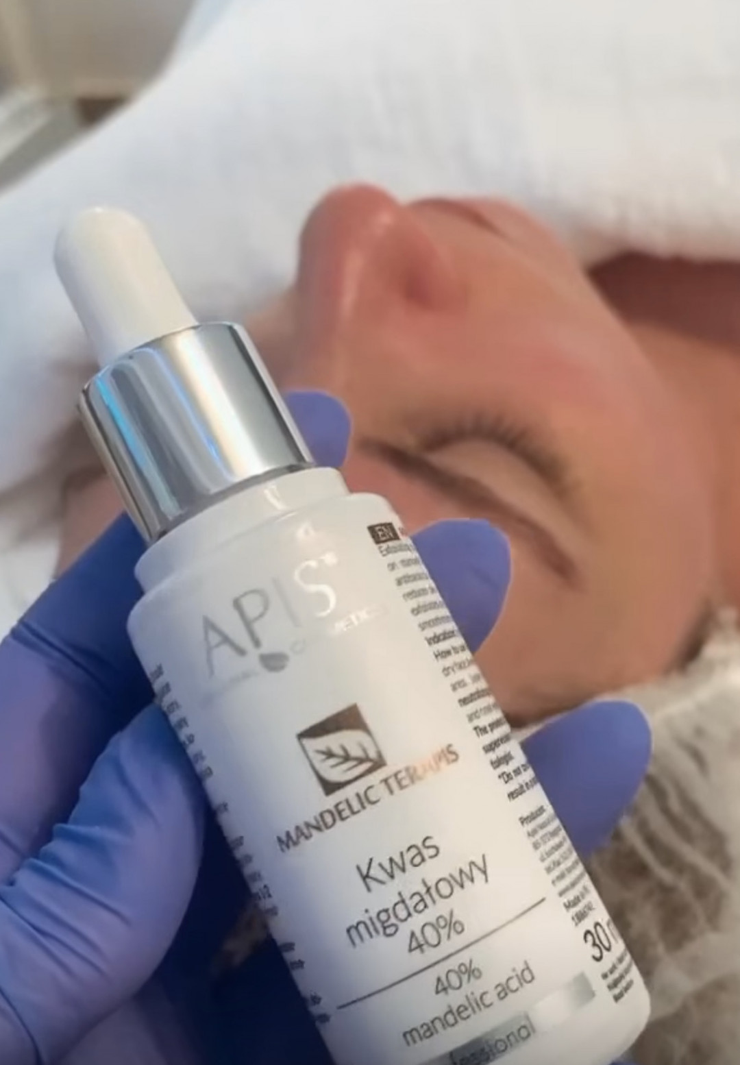 Mint Beauty Boutique #zagreb Akne Acne Therapy - UZ čišćenje + Kemijski peeling 30-40% + LED