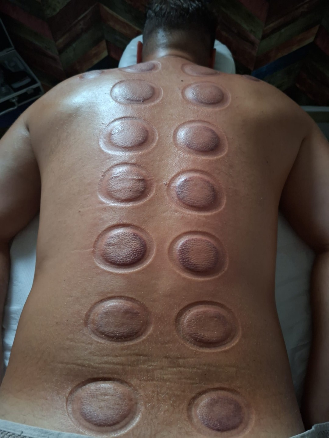 S M Beauty Bloom #zadar Opća masaža Cupping masaža