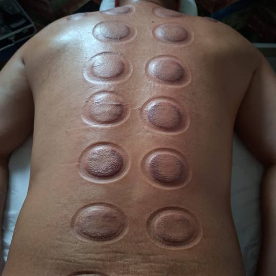 S M Beauty Bloom #zadar Opća masaža Cupping masaža