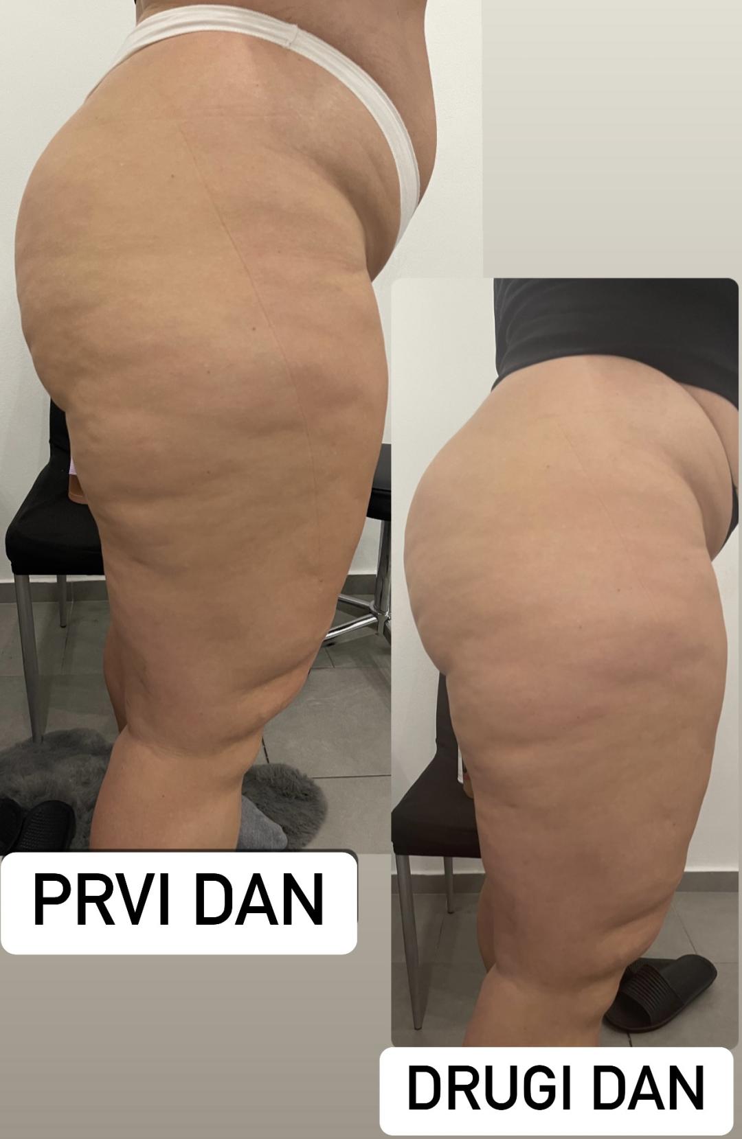 Perfect body beauty bar #zagreb Body wrap / pakovanja Deluxe shape ultrazvučna kavitacija - 60 minuta
