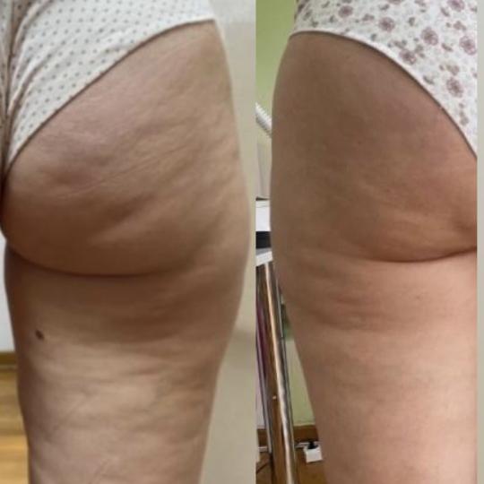 Perfect body beauty bar #zagreb Body wrap / pakovanja Deluxe shape ultrazvučna kavitacija - 60 minu