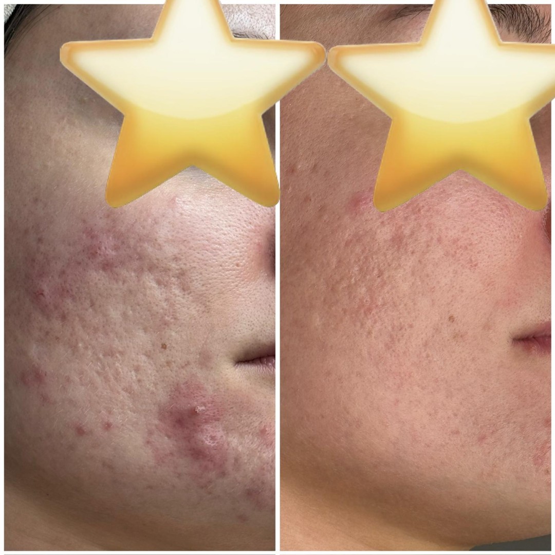 Microneedling lica - 1 regija - Silk skin, Zagreb Mezoterapija lica Lice Mezoterapija lica, Zagreb, Trešnjevka – jug