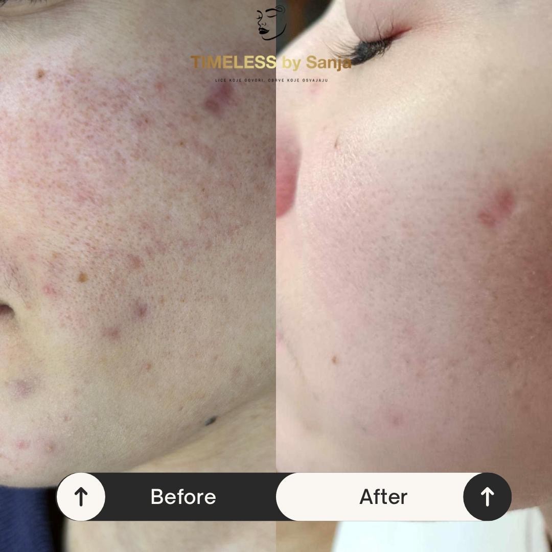 Timeless by Sanja #zagreb Tretman lica KRX - Green sea peel