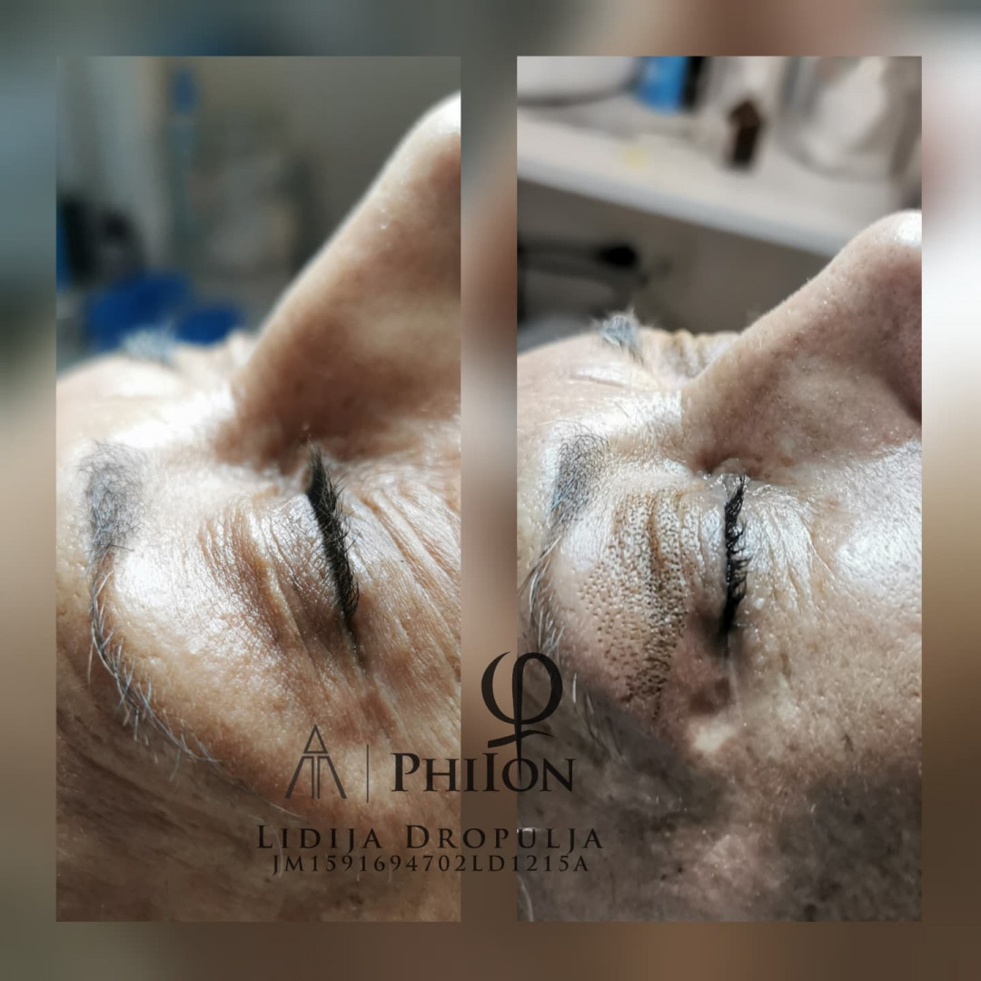 LD Beauty Centar #zagreb Tretmani protiv bora Nekiruško podizanje kapaka