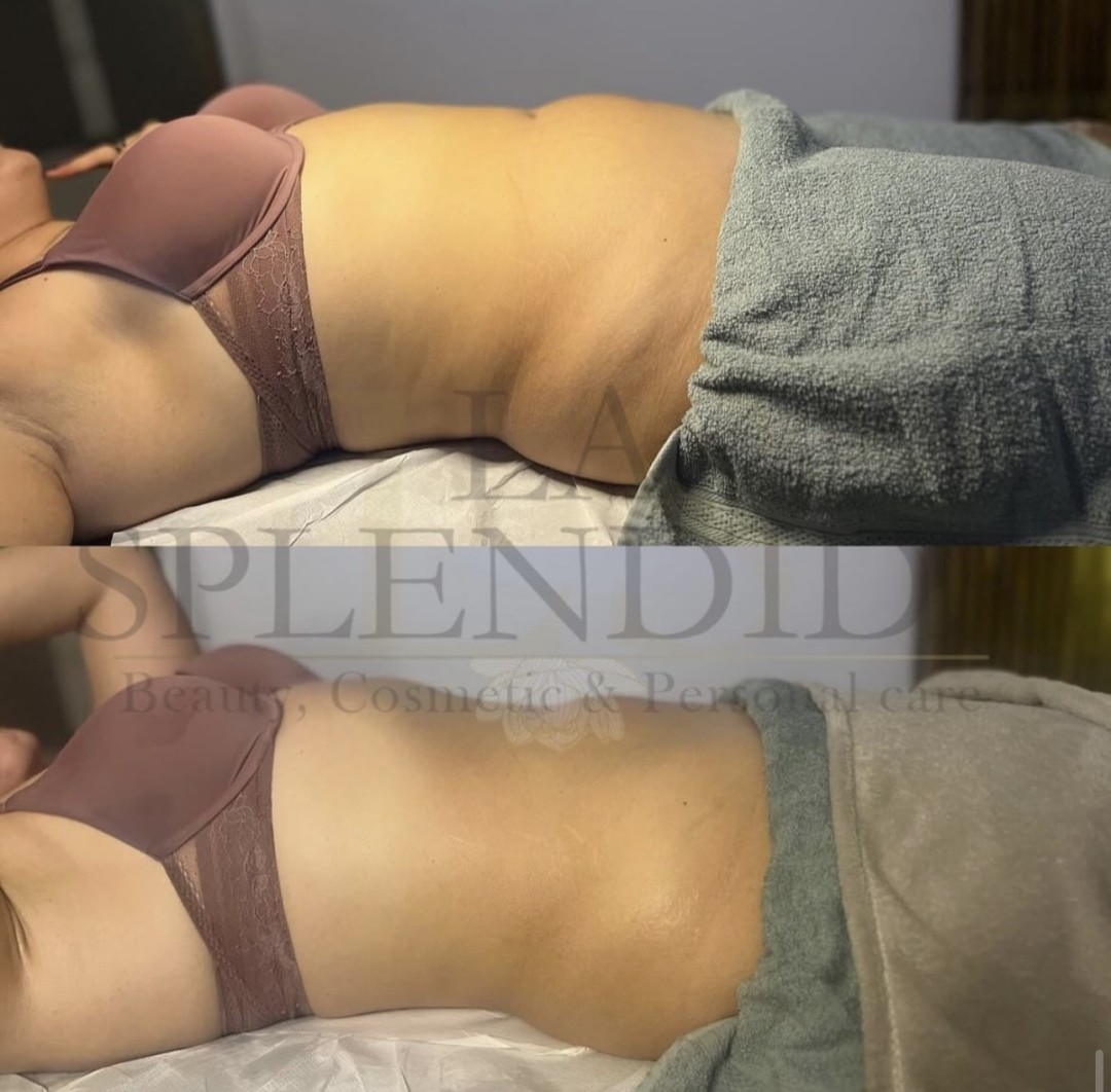 La Splendida #velika-gorica Tretmani tijela Modelirajuća masaža trbuha