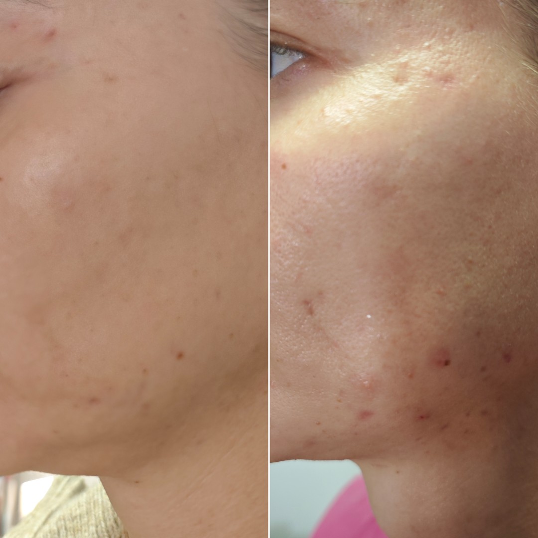 BioLaser Studio Rijeka #rijeka Tretman lica Čišćenje lica