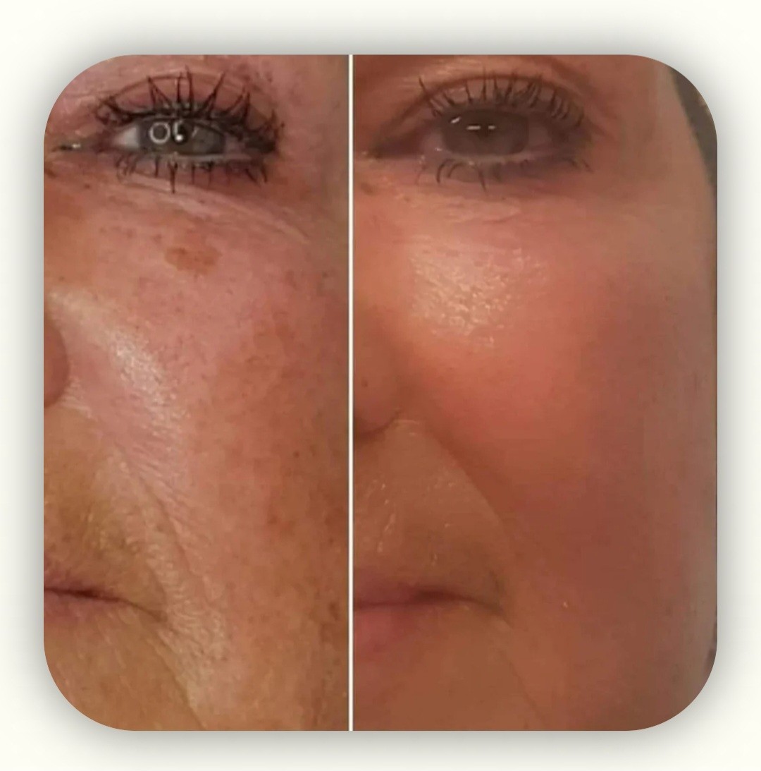 Royal Swiss Beauty #osijek Tretmani protiv bora Royal Swiss Beauty Premium - tretman podmlađivanja lica