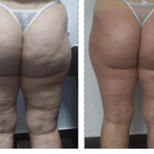 Perfect body beauty bar #zagreb Body wrap / pakovanja Deluxe shape ultrazvučna kavitacija - 60 minu
