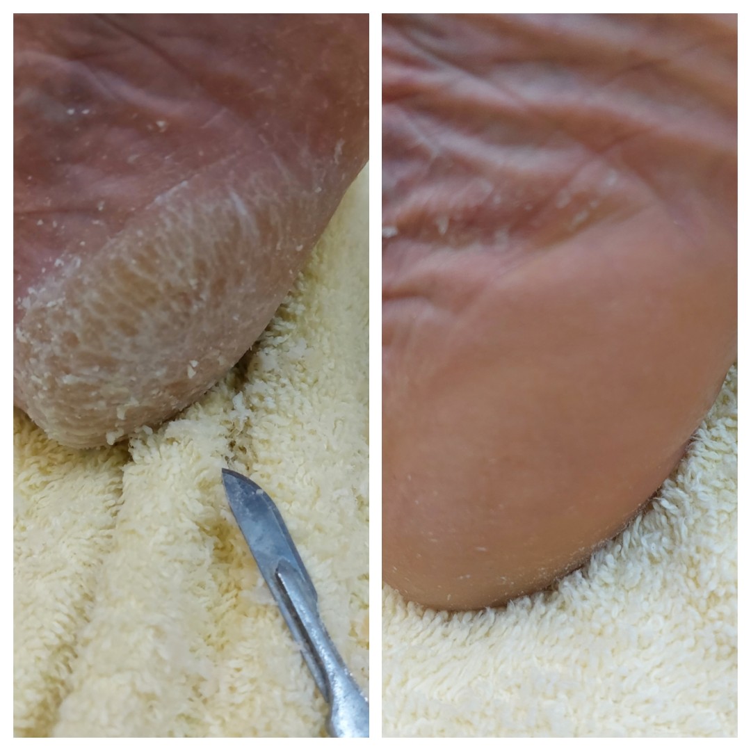 Antiage beauty room Lady Goga #zagreb Medicinska pedikura Pedikura problematičnog stopala