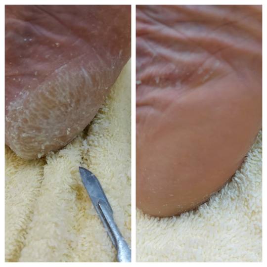 Antiage beauty room Lady Goga #zagreb Medicinska pedikura Pedikura problematičnog stopala