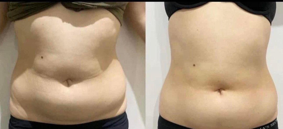 Estetix centar #zagreb Tretmani tijela Emsculpt tretman tijela - paket od 4 tretmana