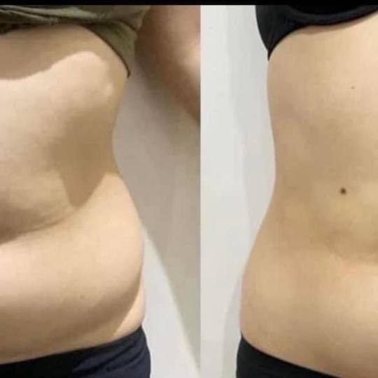 Estetix centar #zagreb Tretmani tijela Emsculpt tretman tijela - paket od 4 tretmana EMSc/ Najbolje 