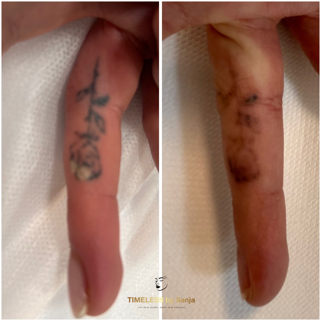 Timeless by Sanja #zagreb Uklanjanje tetovaža Lasersko uklanjanje tetovaža