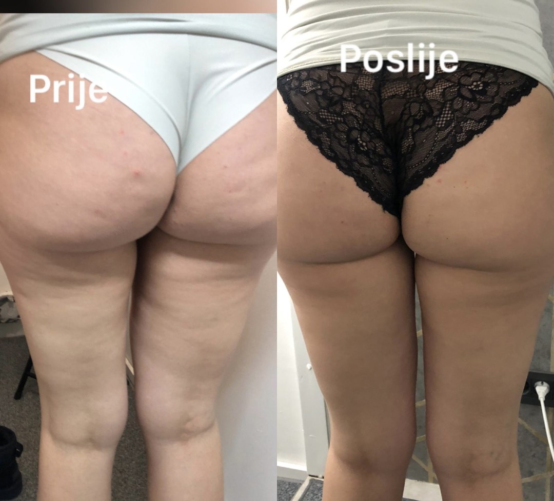 FeelUnique #zagreb Radiovalni i ultrazvučni tretmani LPG oblikovanje + mršavljenje - paket od 10 tretmana + 2 gratis