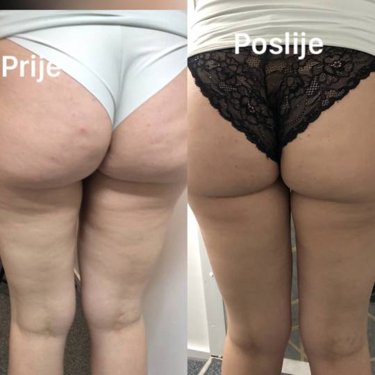 FeelUnique #zagreb Radiovalni i ultrazvučni tretmani LPG oblikovanje + mršavljenje - paket od 10 t