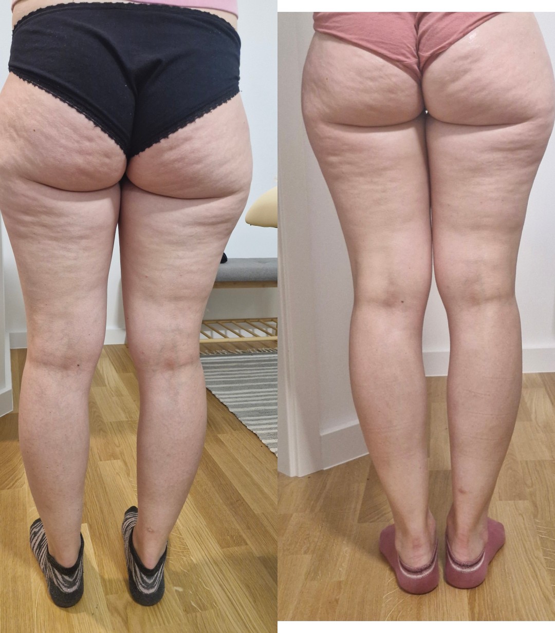 Barbara #zagreb Tretmani tijela Radiofrekvencija tijela - 1 zona