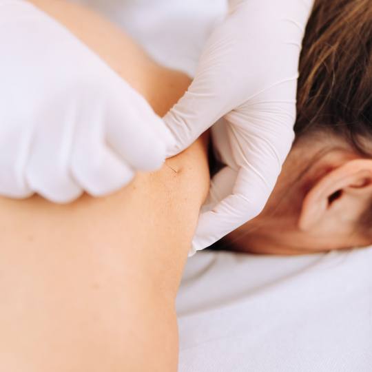 Fizio for You #zagreb Tretmani tijela Dry needling + compex - paket od 2 tretmana + 3 paketa masaža