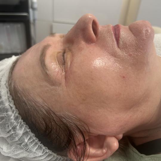 Evi #zagreb Mesoestetic Mesopeel 1 kemijski piling