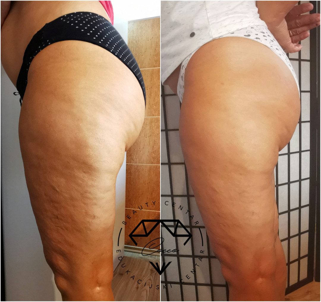 Beauty Centar By Cocco #viskovo Anticelulit masaža