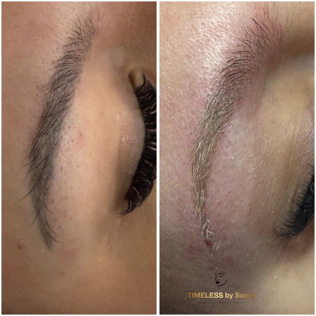 Lasersko uklanjanje obrva - Timeless by Sanja, Zagreb Uklanjanje tetovaža Tijelo Uklanjanje tetovaža, Zagreb, Peščenica – Žitnjak