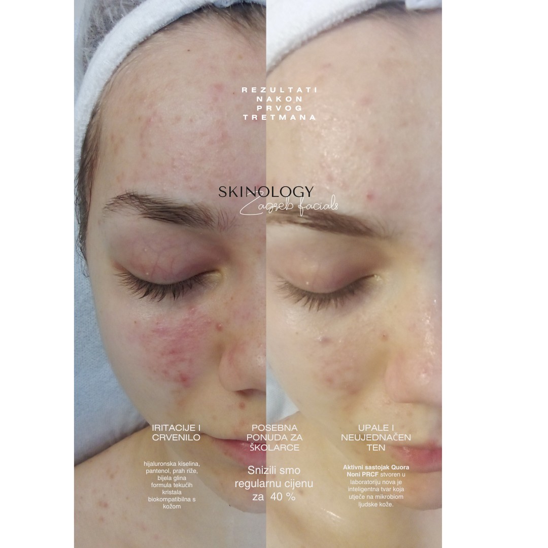 Acne QS Hacker therapy - Skinology Zagreb facials, Zagreb Tretman lica Lice Tretman lica, Zagreb, Donji grad - Centar