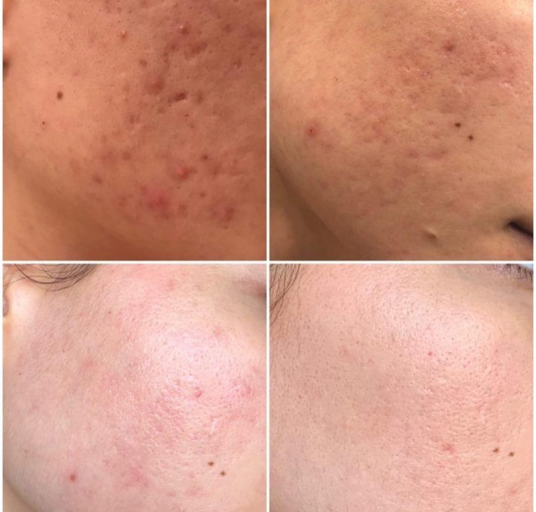 Perfect body beauty bar #zagreb Dermaroler i dermapen Dermapen exosomi - lice